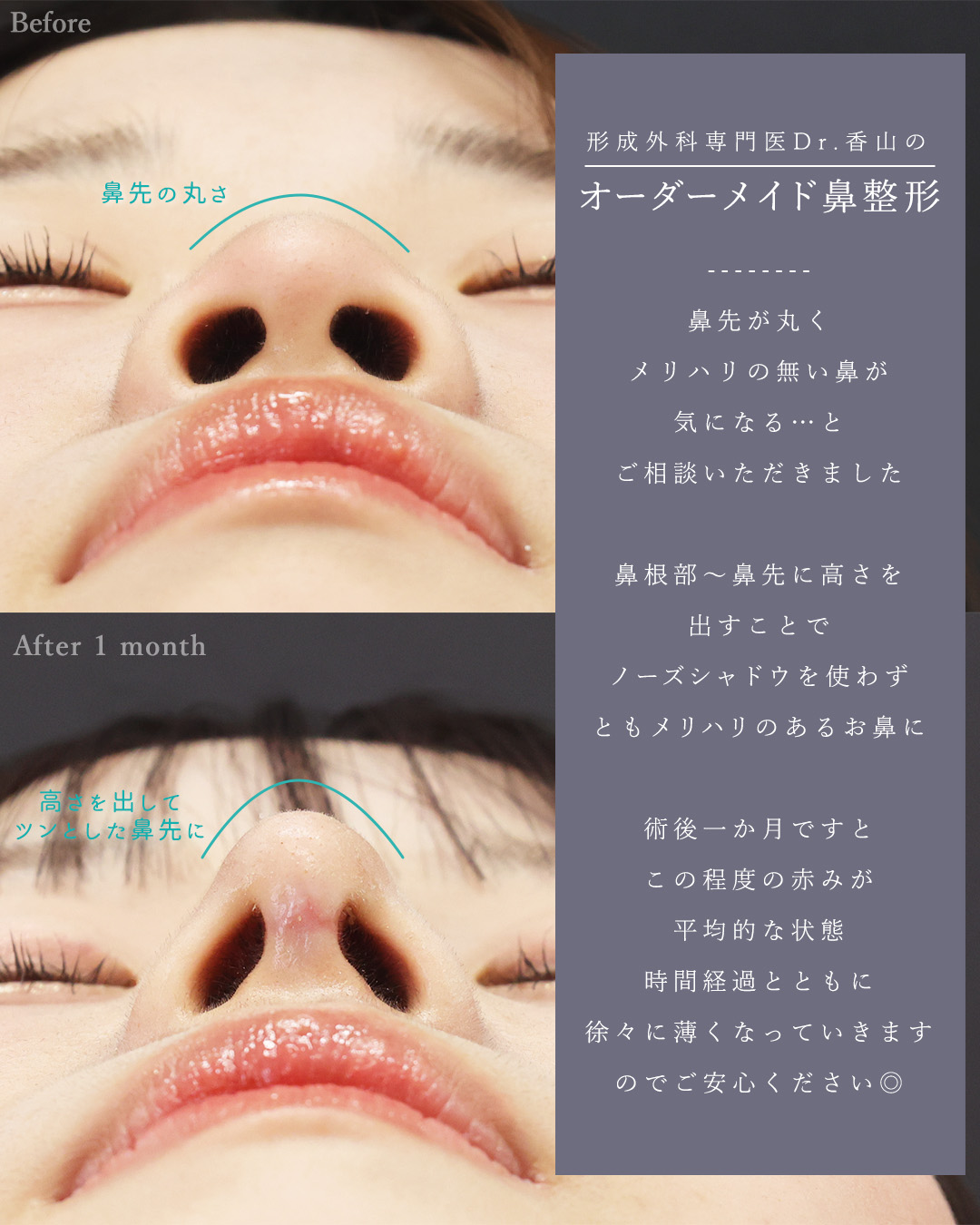 顔の脂肪吸引/バッカルファット除去/TAC式 ツヤ肌コラーゲンリフト®の症例写真 施術前後