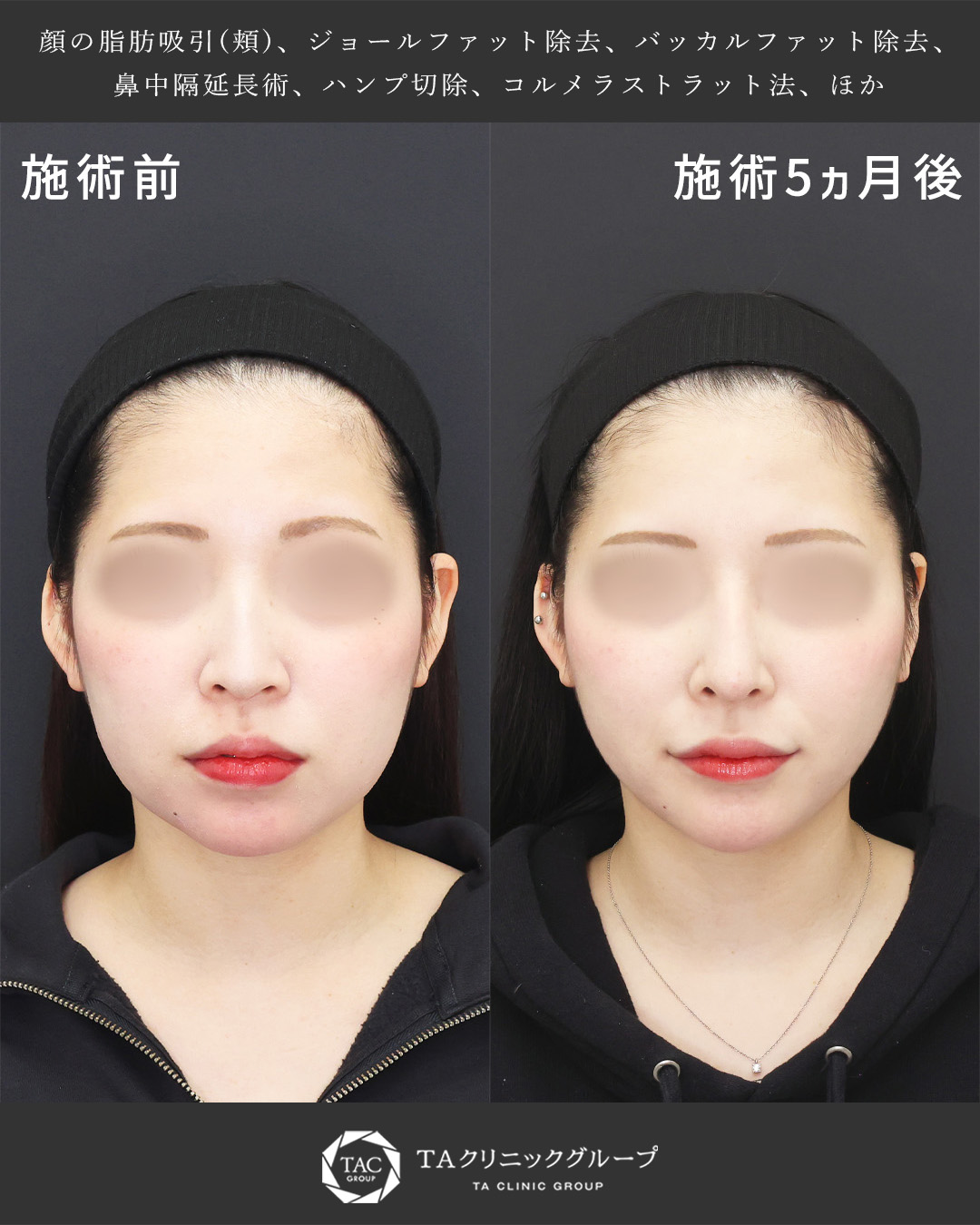 鼻フル整形×小顔整形|中顔面を短縮し、理想の垢抜けを叶える【長期経過症例】