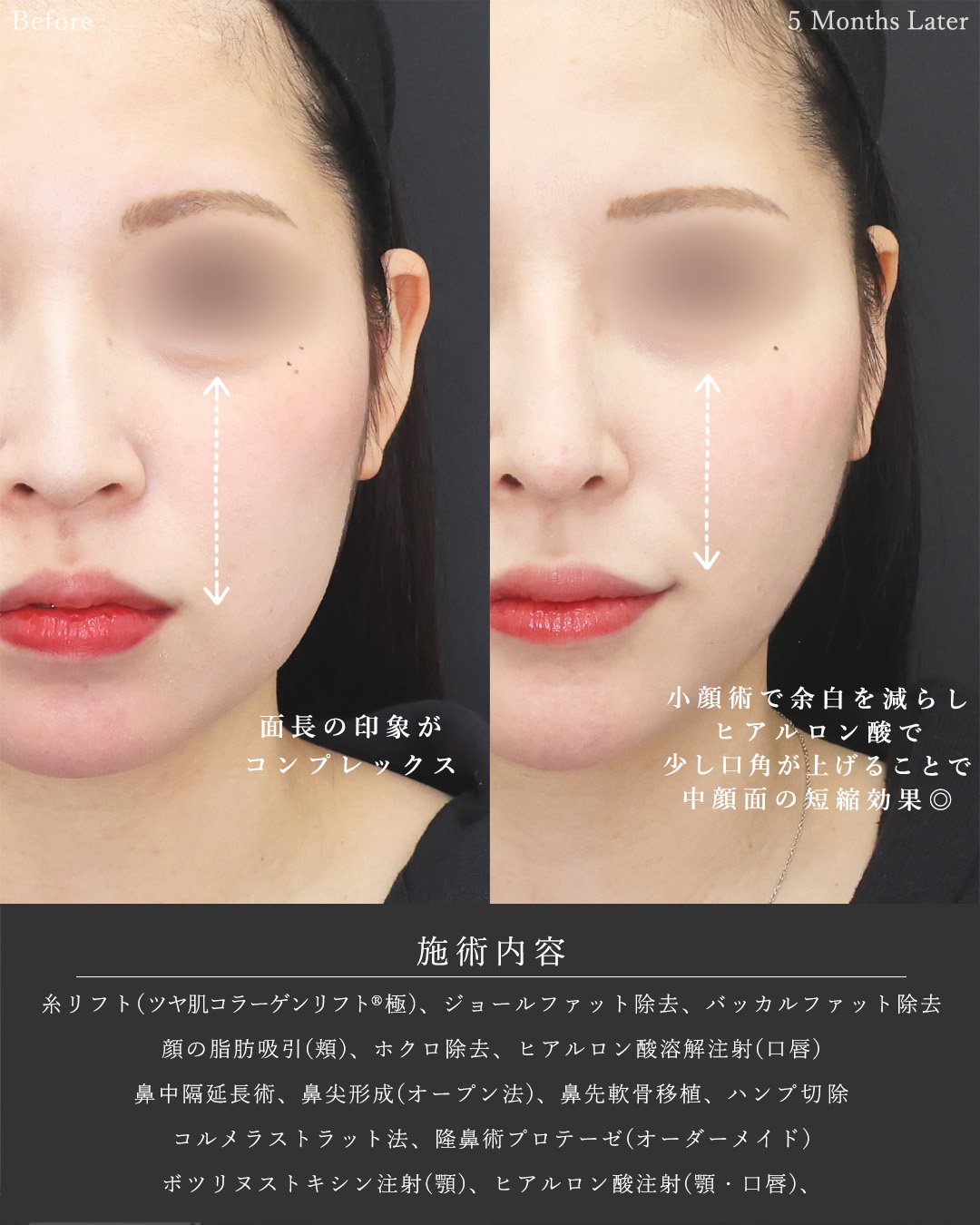 鼻中隔延長術/顔の脂肪吸引/ジョールファット除去の症例写真 施術前後 