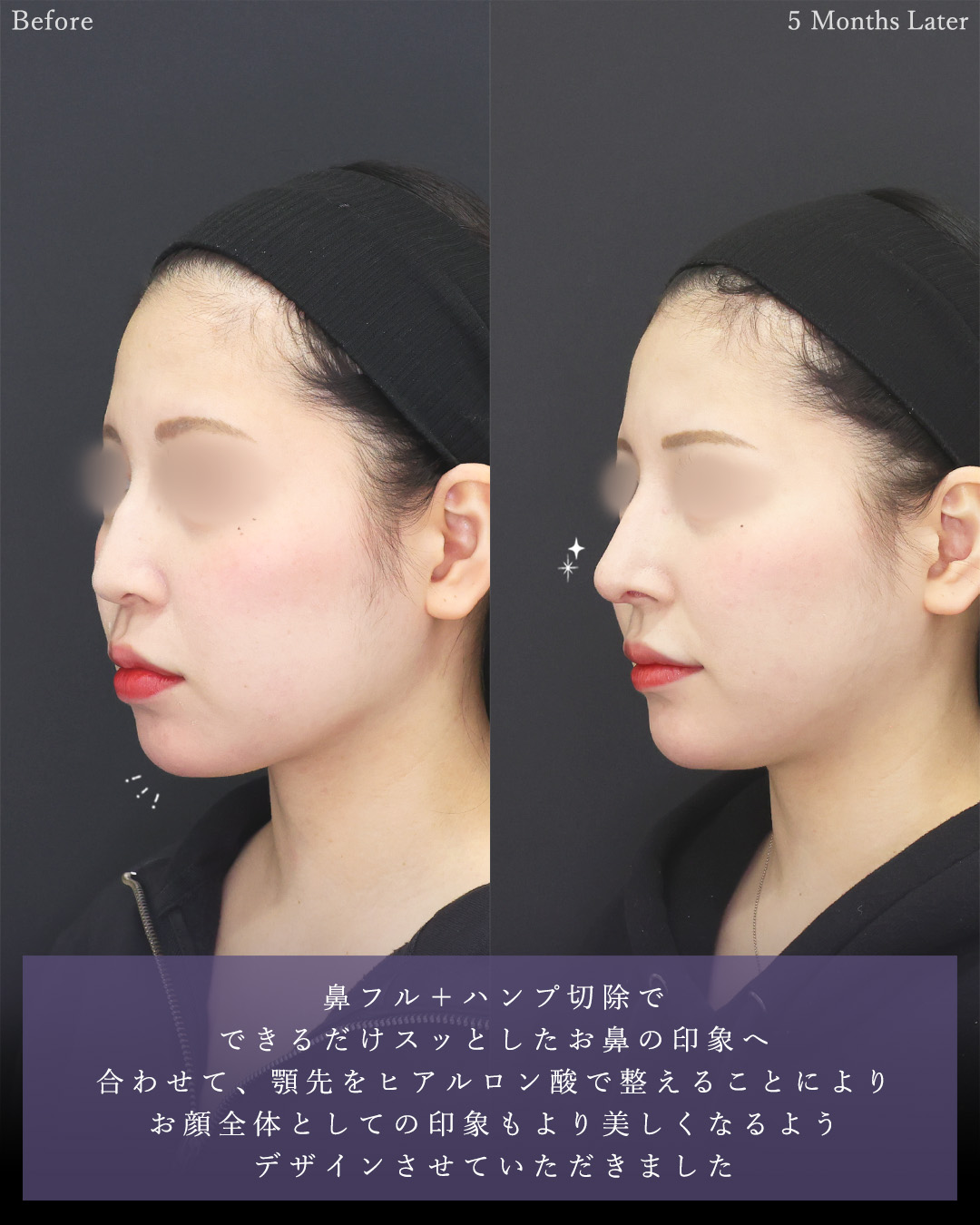 鼻中隔延長術/顔の脂肪吸引/ジョールファット除去の症例写真 施術前後 