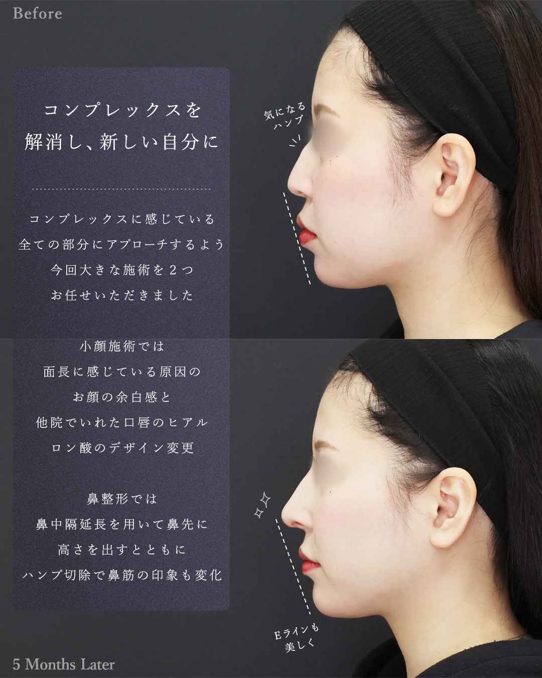 鼻中隔延長術/顔の脂肪吸引/ジョールファット除去の症例写真 施術前後 