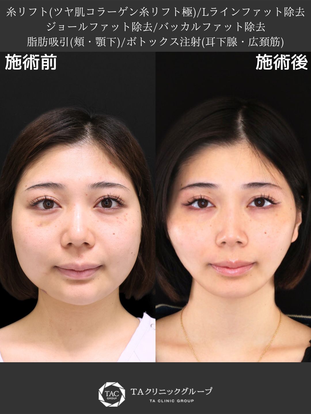 【Dr.Marieの美的バランス調整術】頬の脂肪感を取り除き、洗練された大人顔へ変身！
