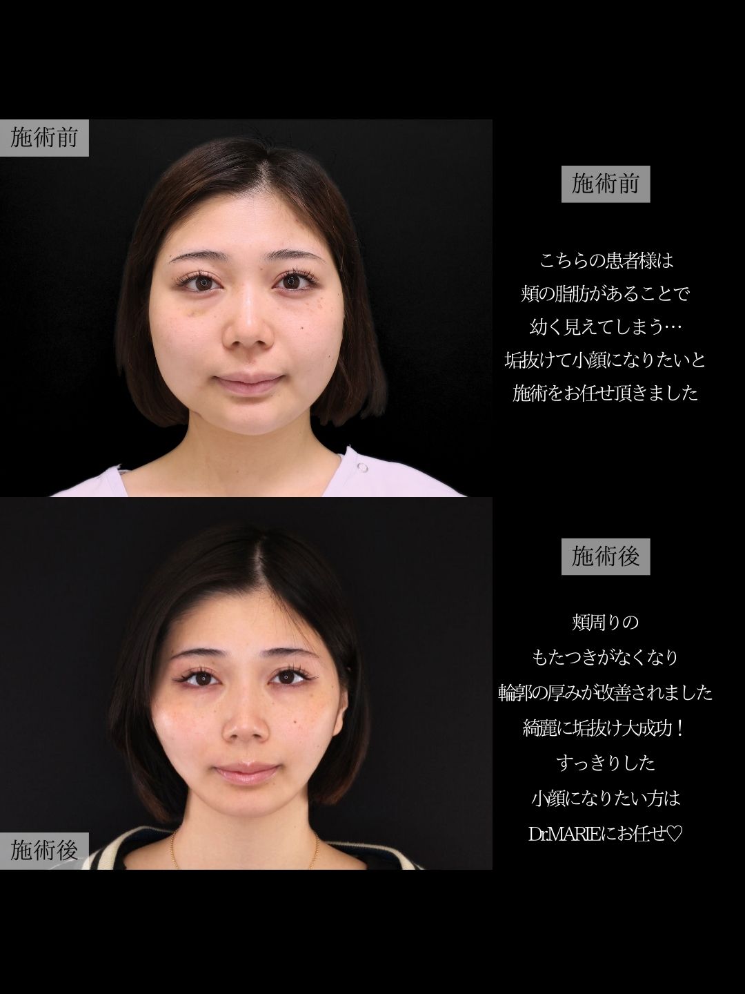 TAC式 ツヤ肌コラーゲンリフト®/バッカルファット除去/ジョールファット除去の症例写真 施術前後 