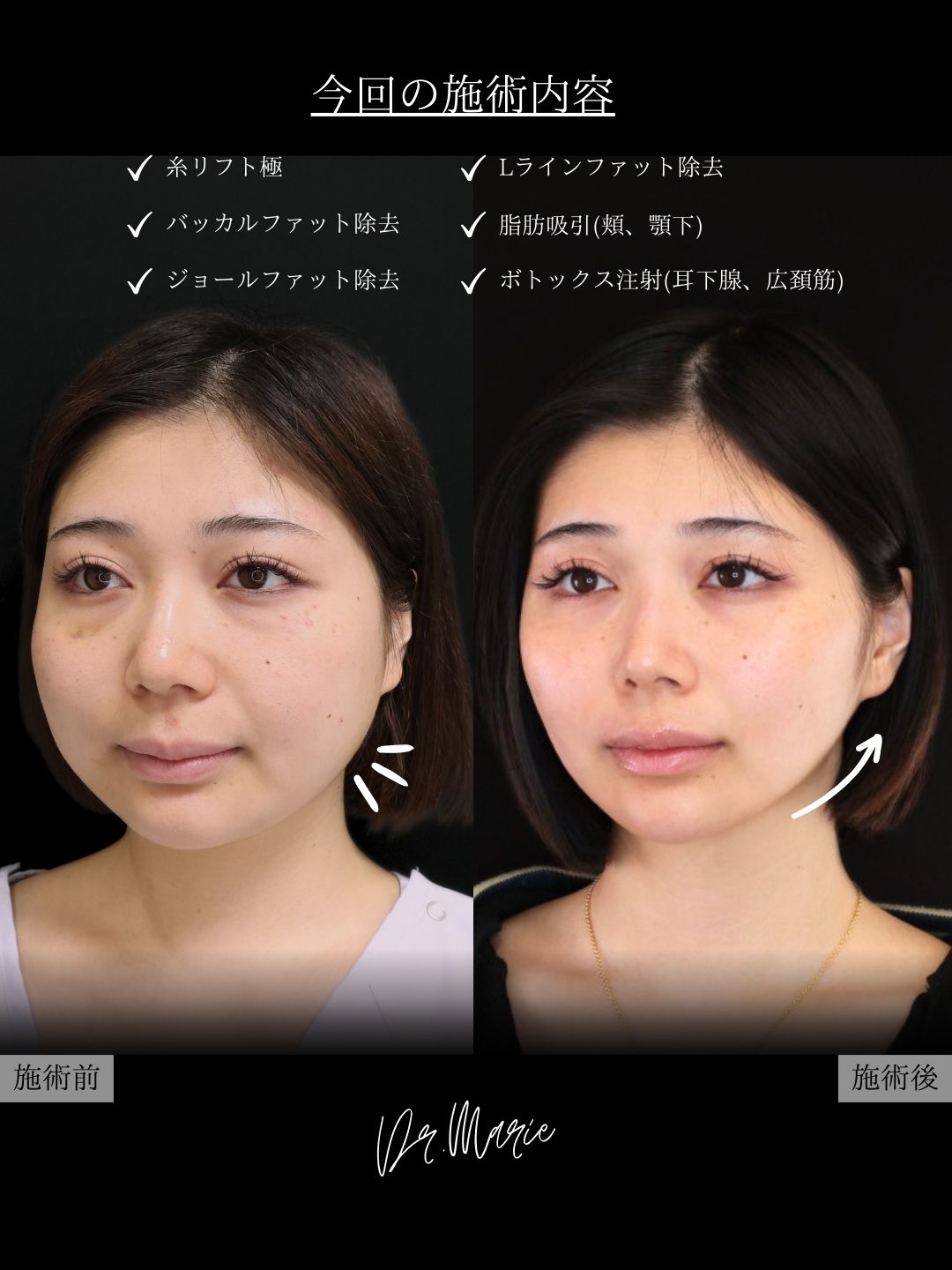 TAC式 ツヤ肌コラーゲンリフト®/バッカルファット除去/ジョールファット除去の症例写真 施術前後 