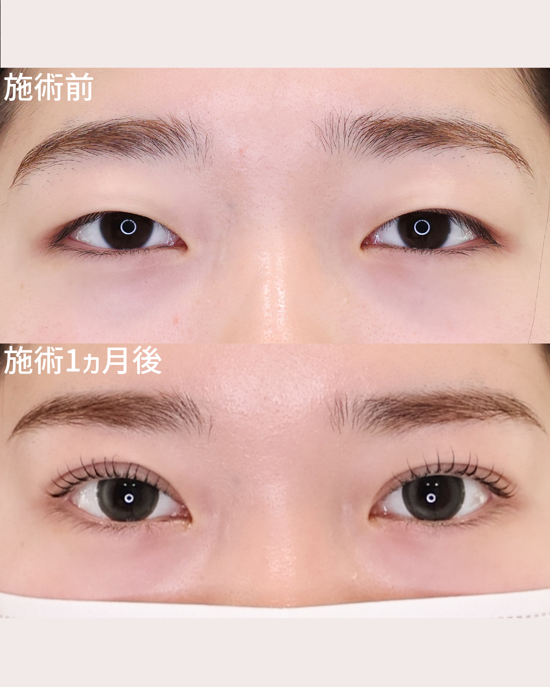 誰だって垢抜け美少女になれる。【二重埋没】