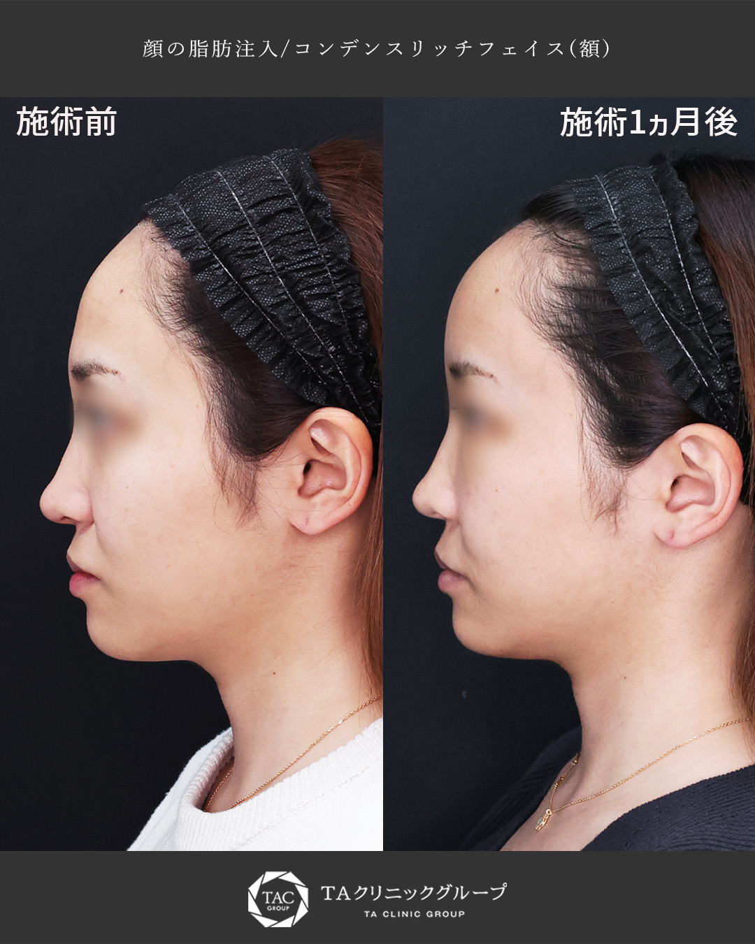 脂肪注入で自然な丸い額に