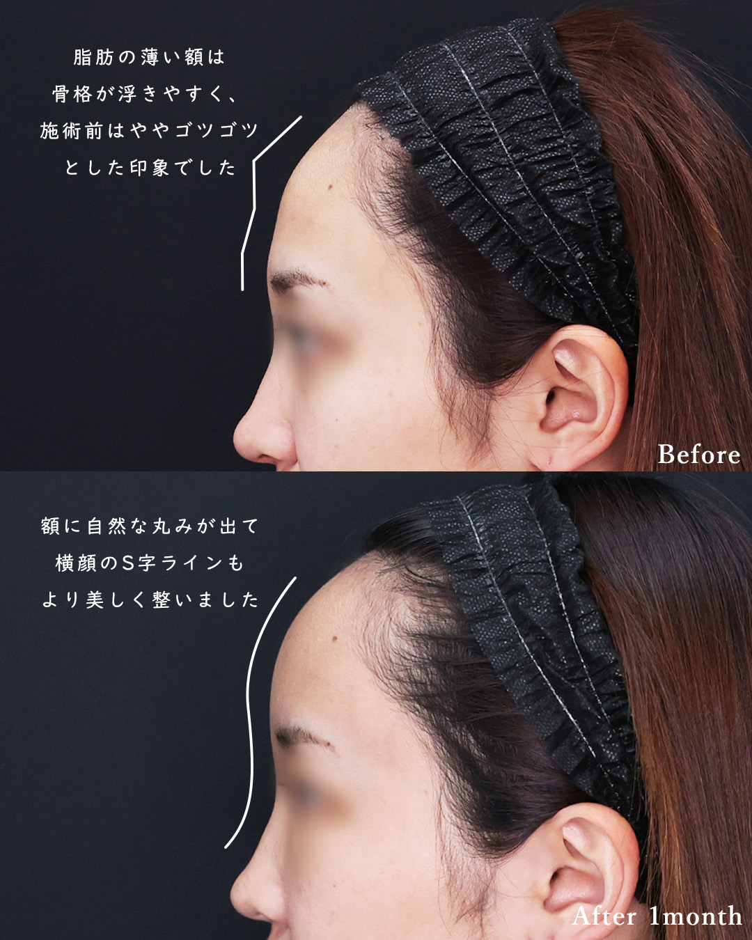 おでこの脂肪注入（オルチャンデコ形成）の症例写真 施術前後 