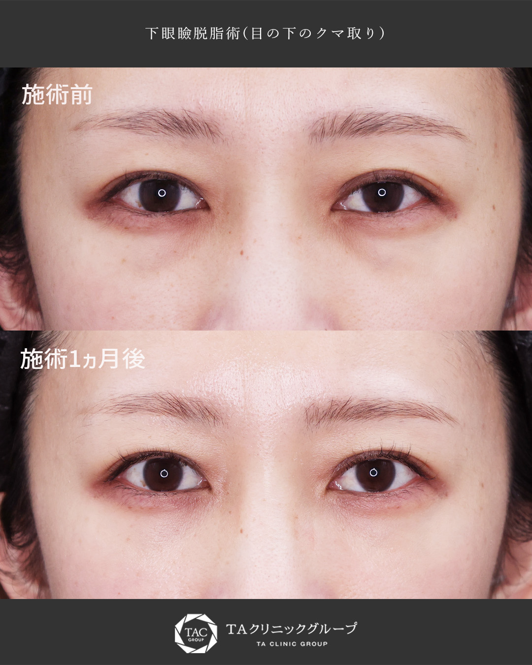 メイクで隠せない【黒クマ】もすっきり改善