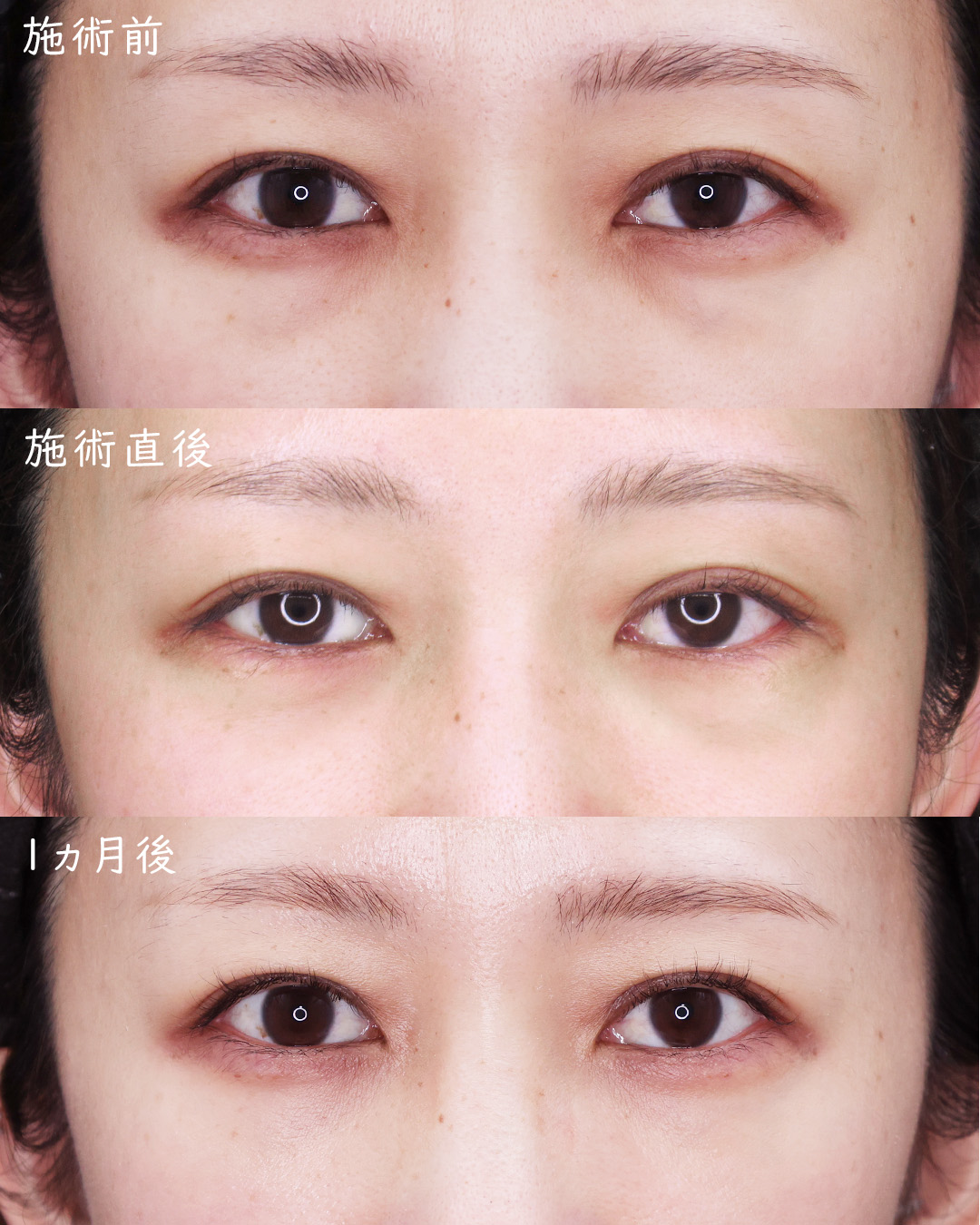 下眼瞼脱脂術（目の下のたるみ取り・目の下の脂肪ふくらみ取り）の症例写真 施術前後 