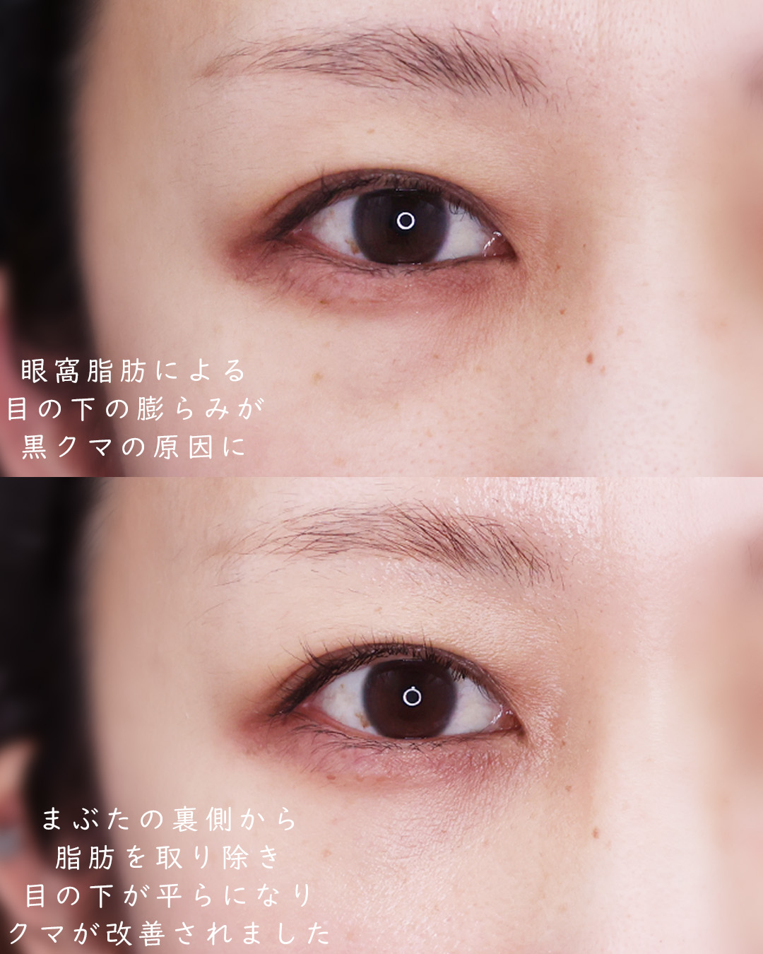 下眼瞼脱脂術（目の下のたるみ取り・目の下の脂肪ふくらみ取り）の症例写真 施術前後 