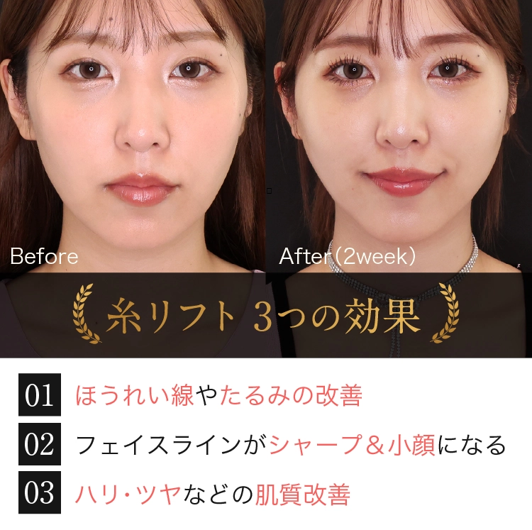 糸リフトの効果の説明とBefore/After写真