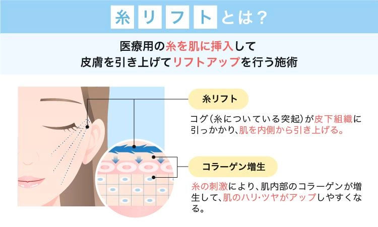 糸リフトの施術方法と効果を解説した画像