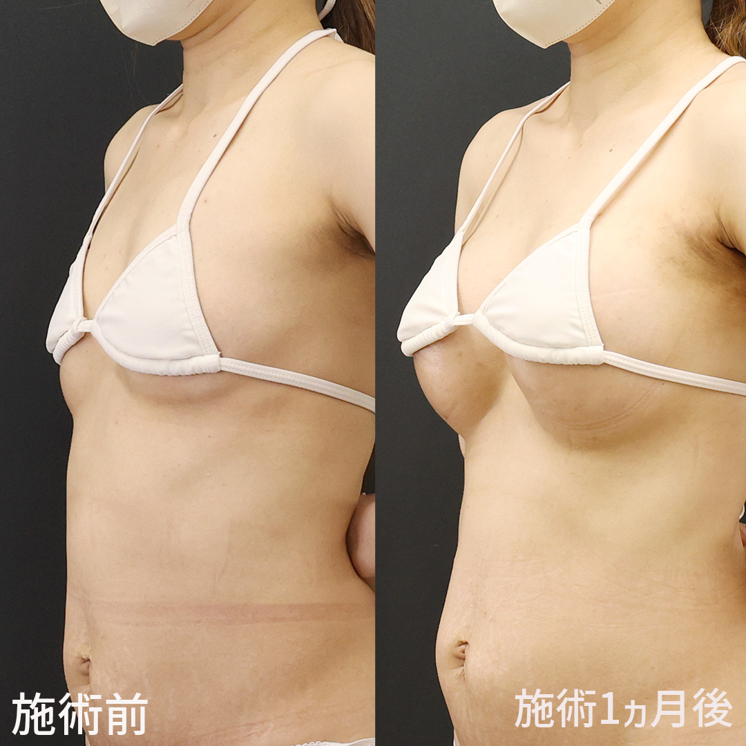 【シリコンバッグ豊胸】元々の胸のサイズをとりもどす