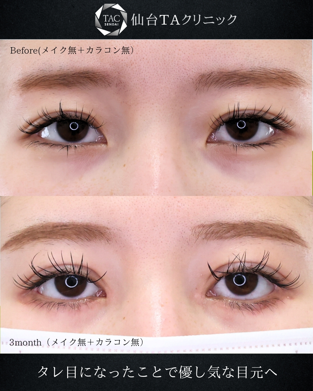 グラマラスライン（タレ目形成）/二重埋没法/目頭切開術の症例写真 施術前後 