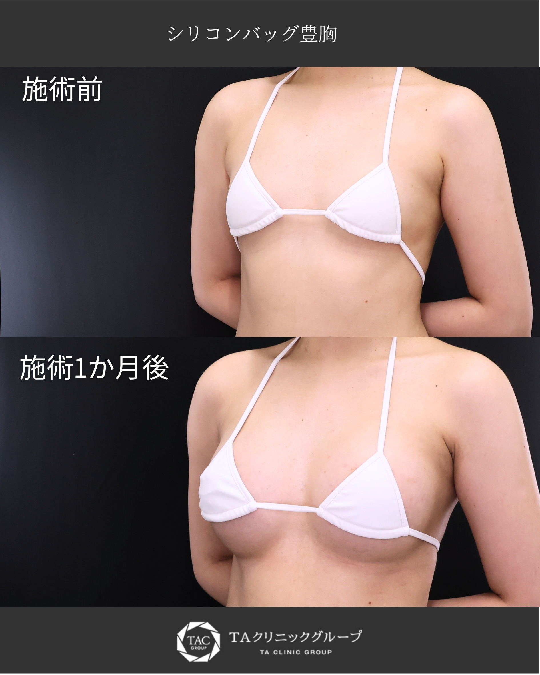 【シリコンバッグ豊胸】ボリュームのあるバストへ大変身！