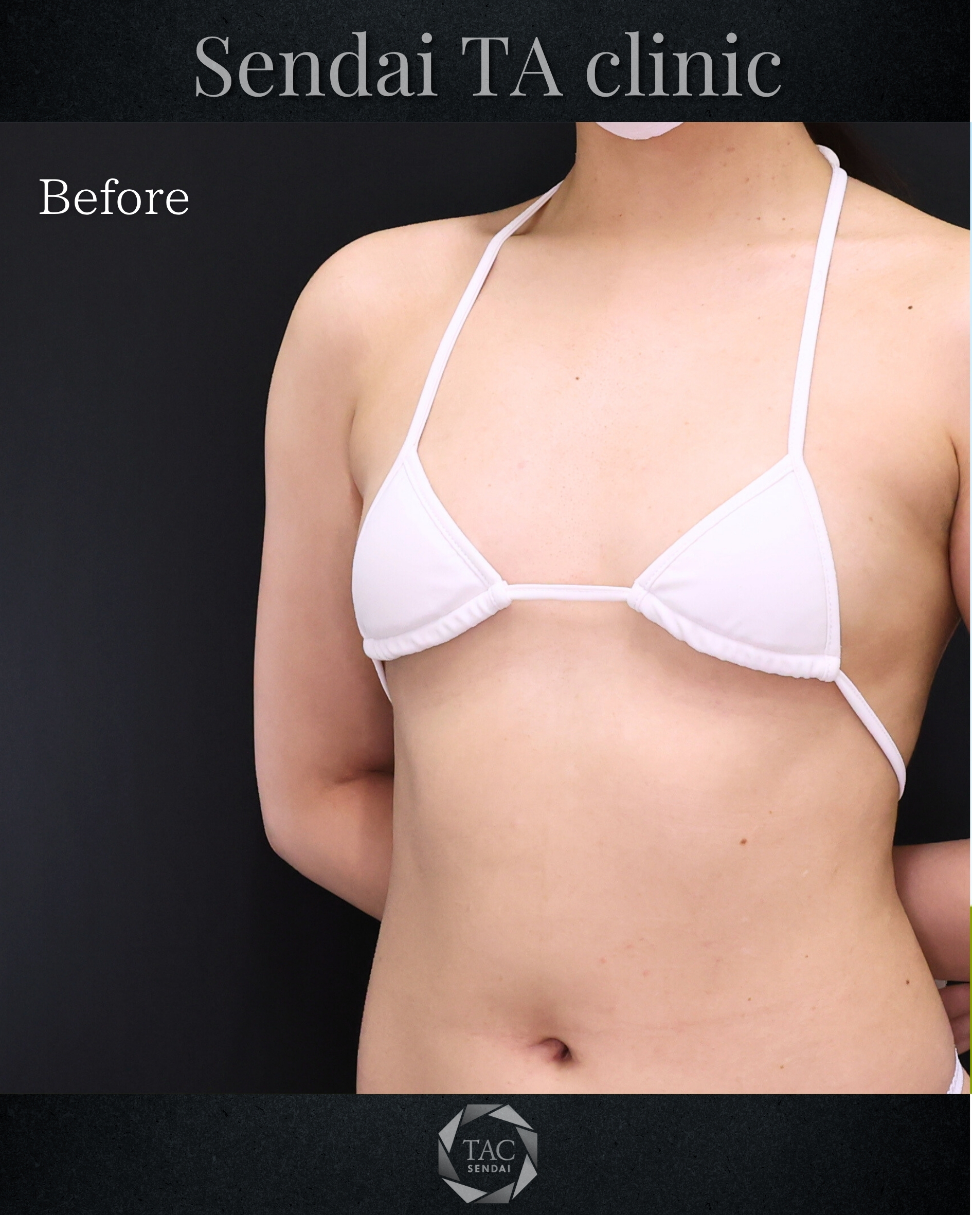 シリコンバッグ豊胸（人工乳腺バッグ）の症例写真 施術前後 