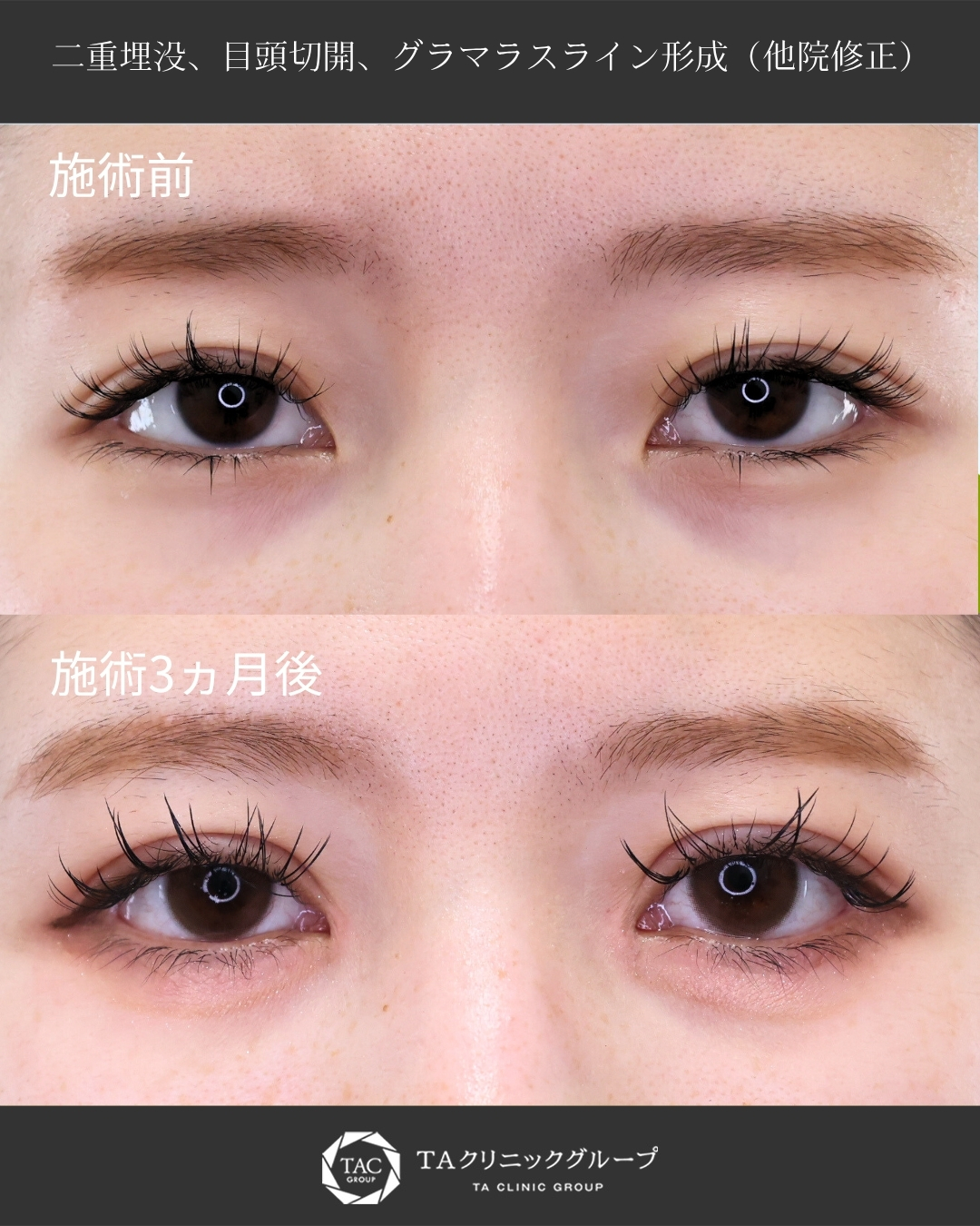 全方向拡大で憧れのドールアイを実現【二重埋没/目頭切開/グラマラスライン形成】
