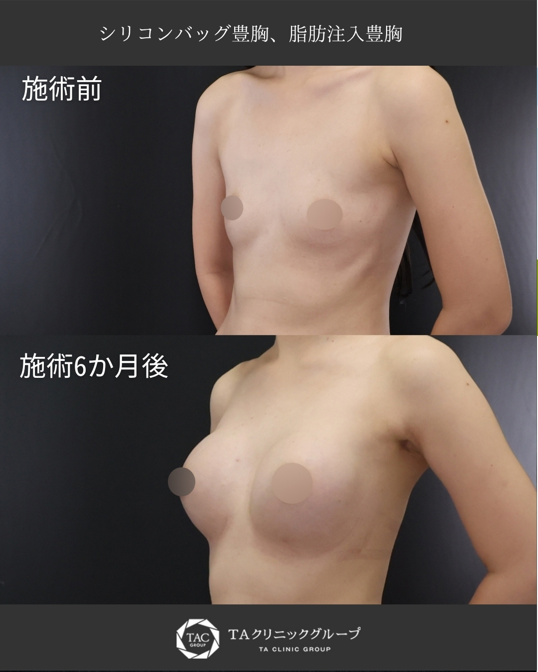 ハイブリット豊胸【シリコンバッグ豊胸＋脂肪注入豊胸】