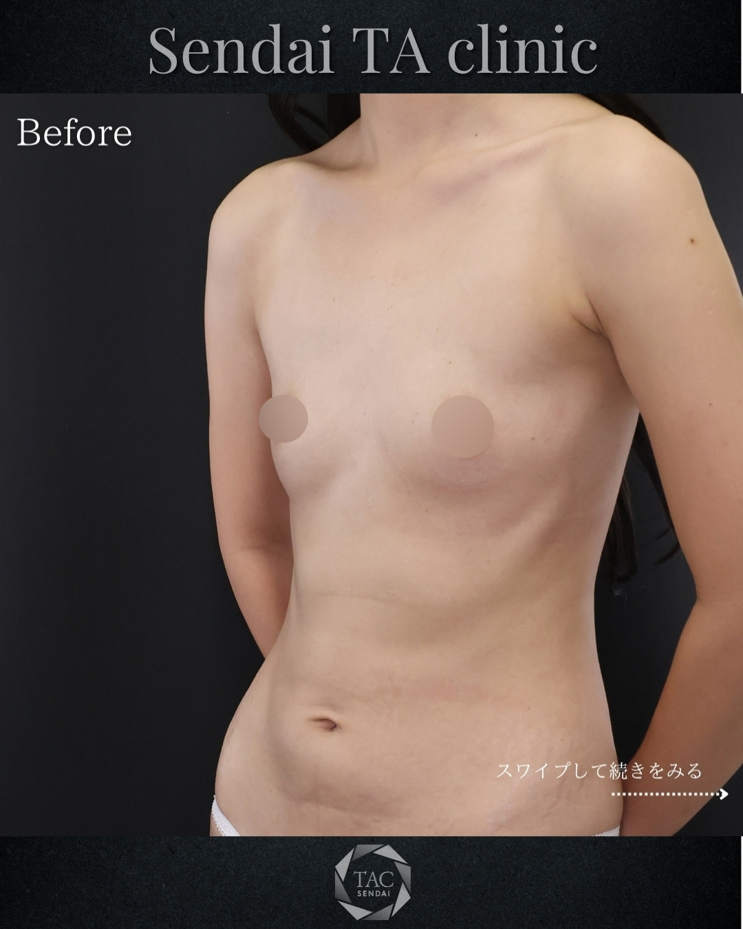 シリコンバッグ豊胸（人工乳腺バッグ）/脂肪注入豊胸（コンデンスリッチ・ピュアグラフト・１day脂肪豊胸）の症例写真 施術前後 