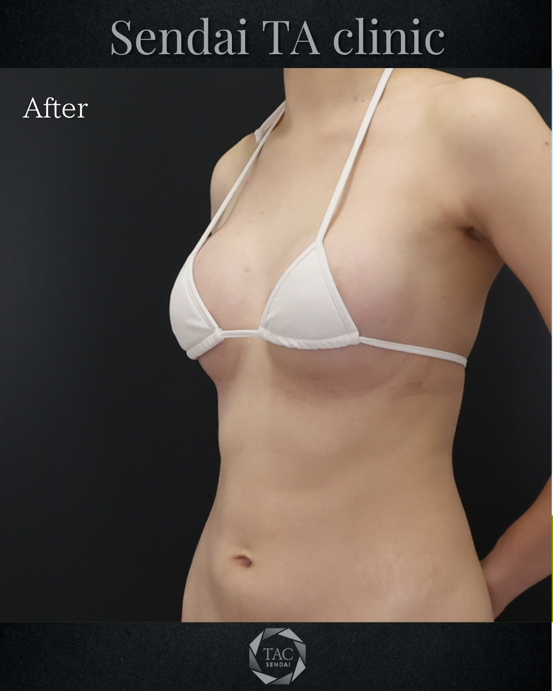 シリコンバッグ豊胸（人工乳腺バッグ）/脂肪注入豊胸（コンデンスリッチ・ピュアグラフト・１day脂肪豊胸）の症例写真 施術前後 