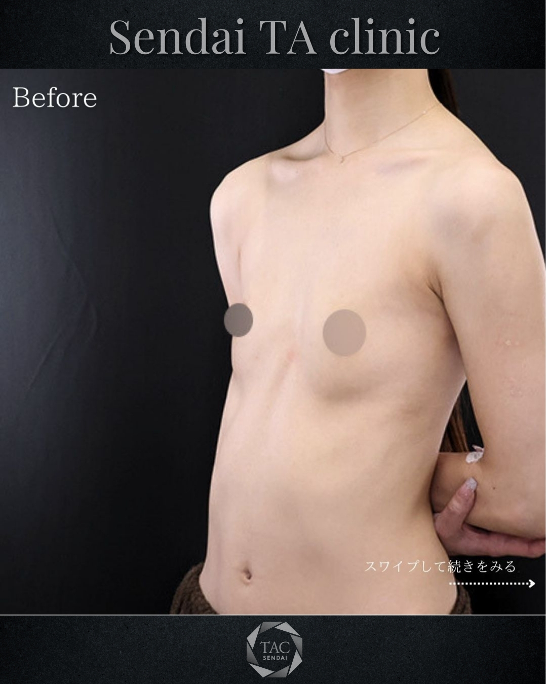 シリコンバッグ豊胸（人工乳腺バッグ）の症例写真 施術前後 