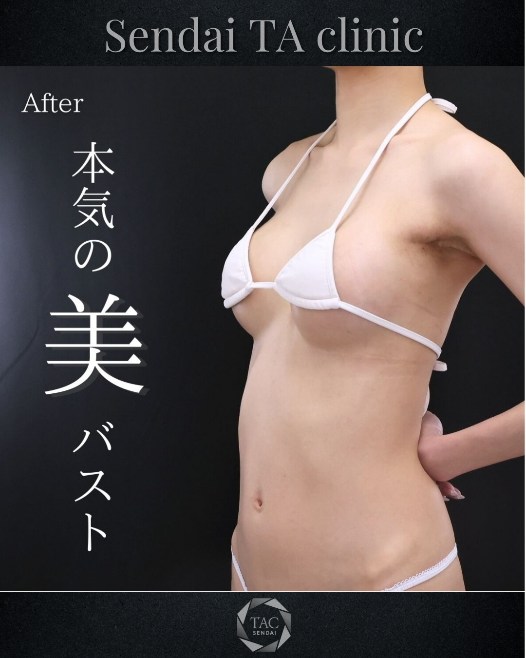 シリコンバッグ豊胸（人工乳腺バッグ）の症例写真 施術前後 