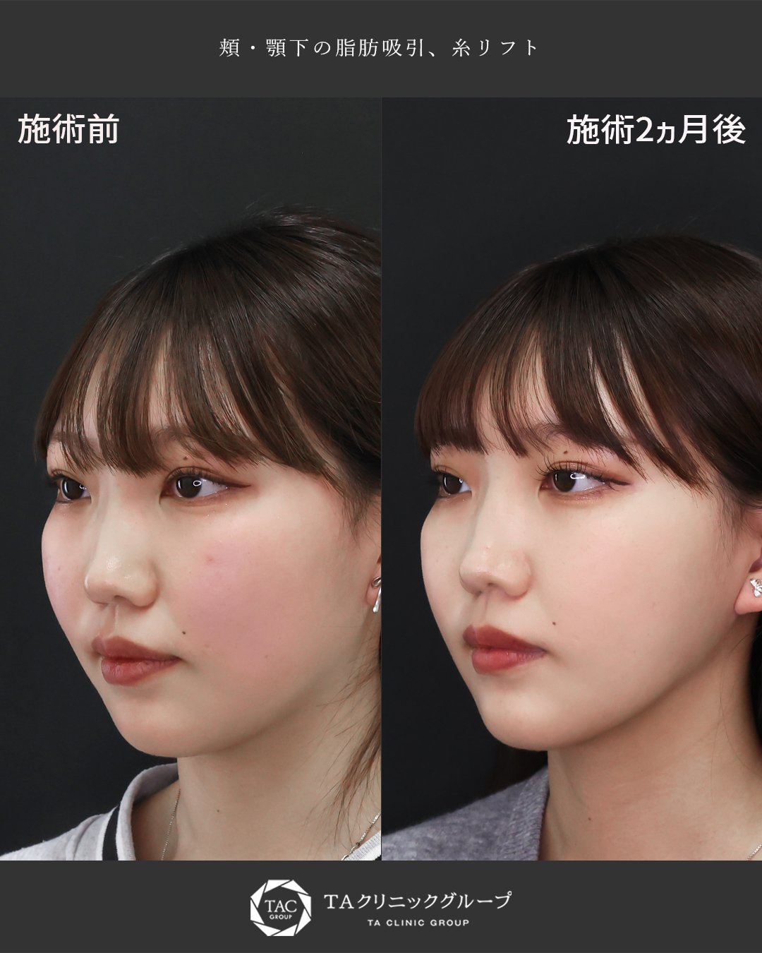 『顎下限界突破』小顔術