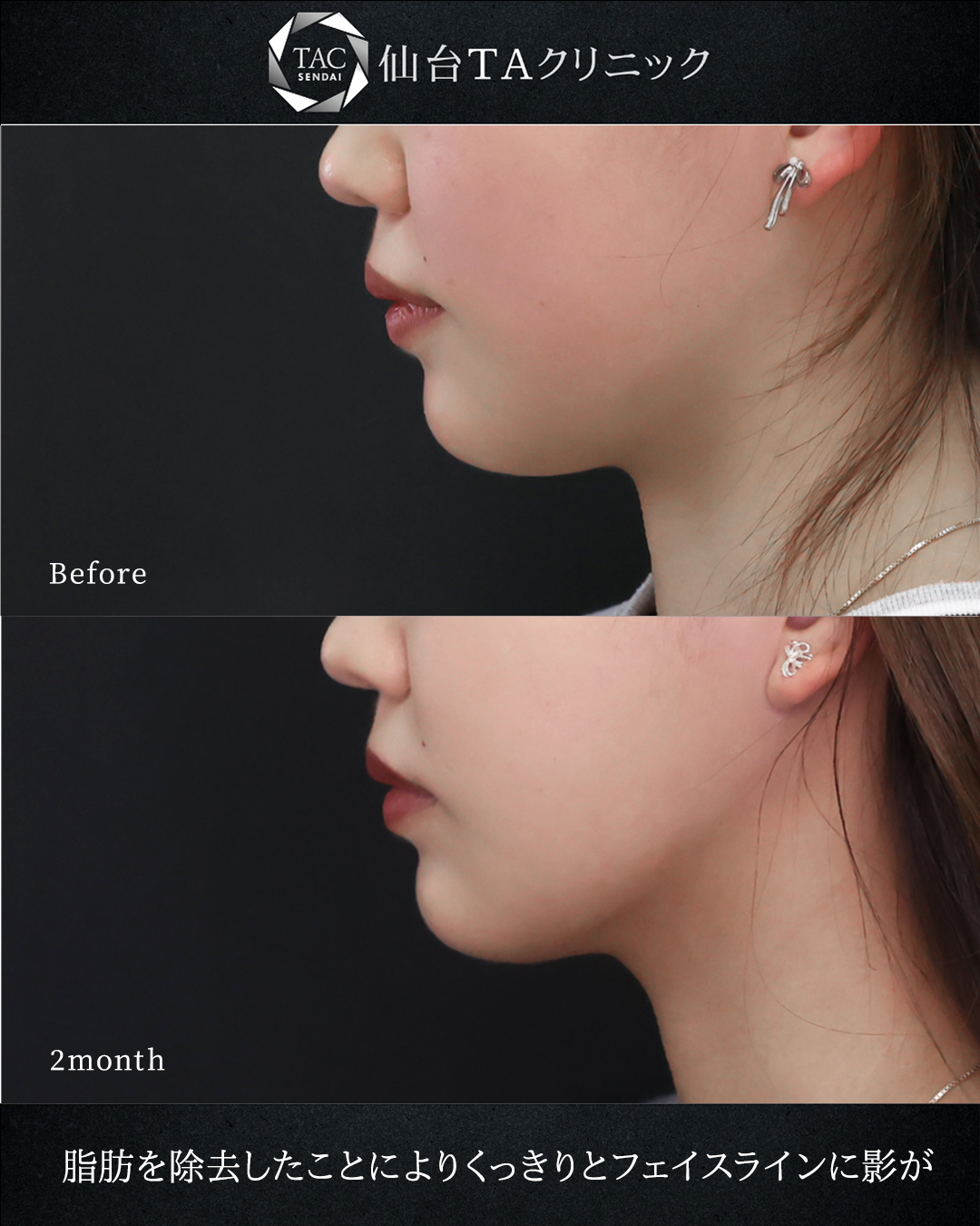 顔の脂肪吸引/TAC式 ツヤ肌コラーゲンリフト®の症例写真 施術前後 