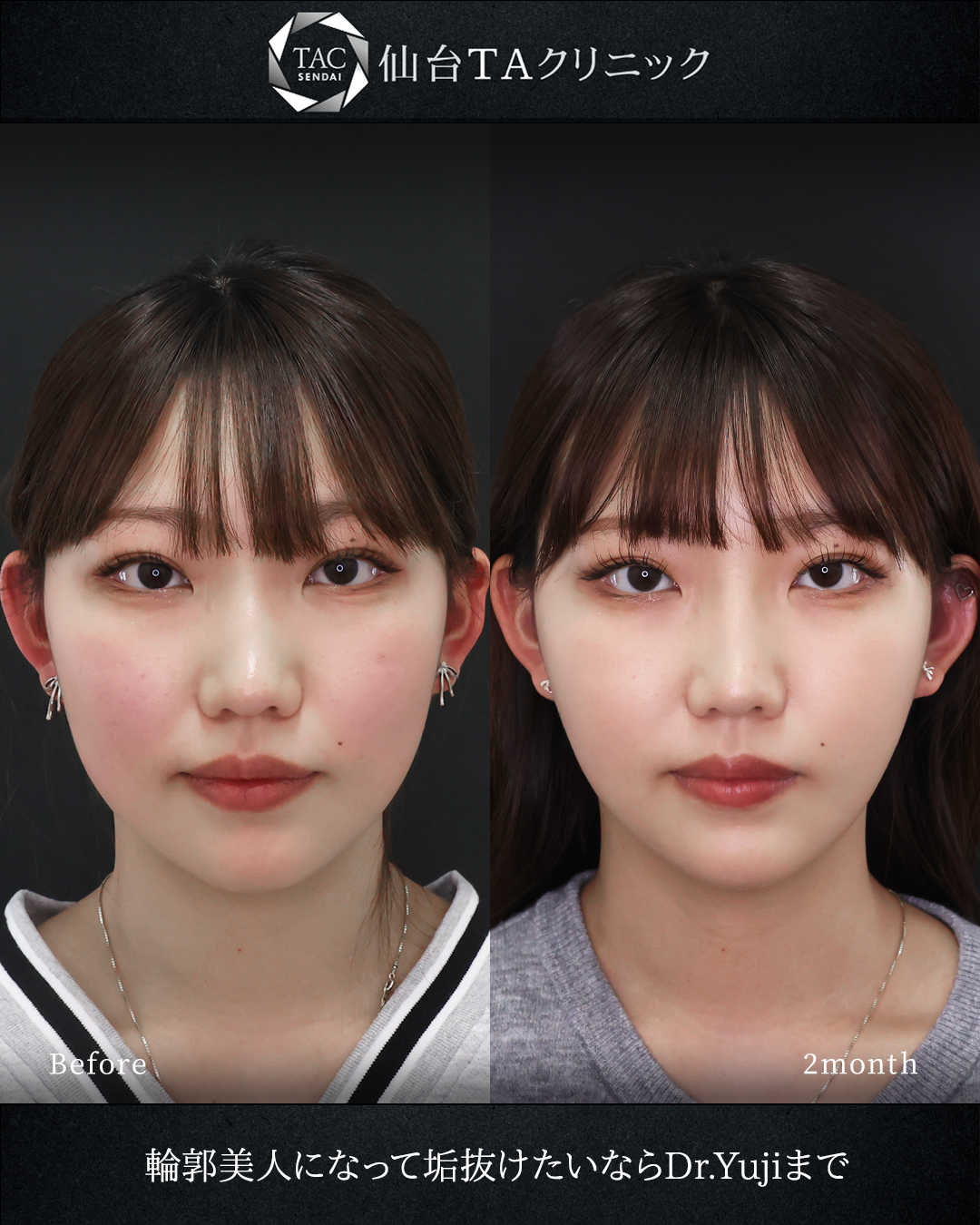 顔の脂肪吸引/TAC式 ツヤ肌コラーゲンリフト®の症例写真 施術前後 