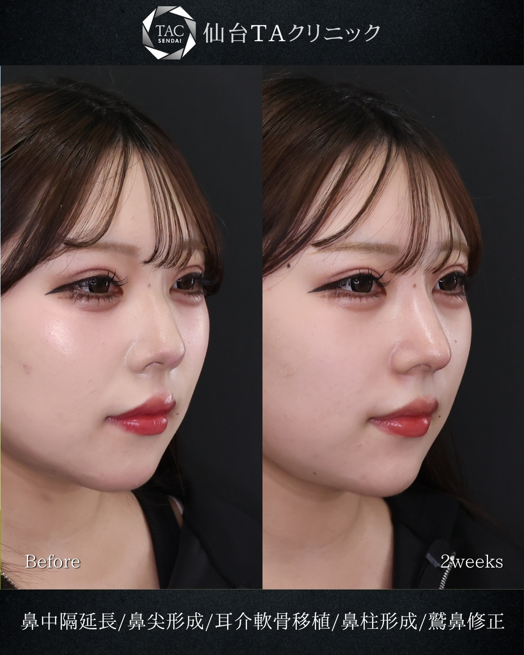 鼻中隔延長術/鼻尖形成・鼻尖縮小の症例写真 施術前後 