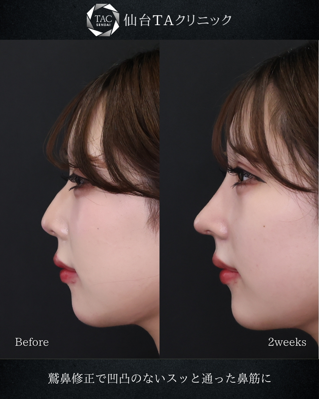 鼻中隔延長術/鼻尖形成・鼻尖縮小の症例写真 施術前後 