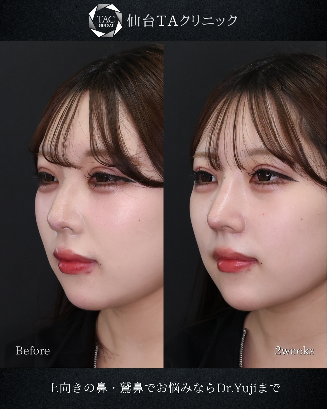 鼻中隔延長術/鼻尖形成・鼻尖縮小の症例写真 施術前後 