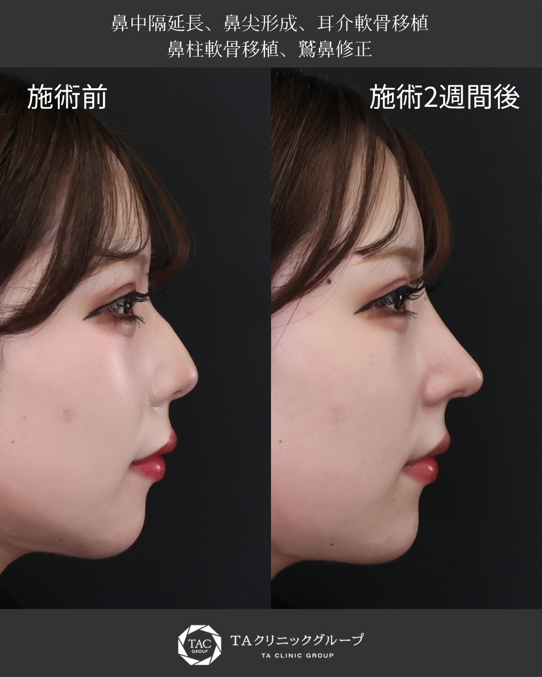 【鼻フル整形】２週間経過