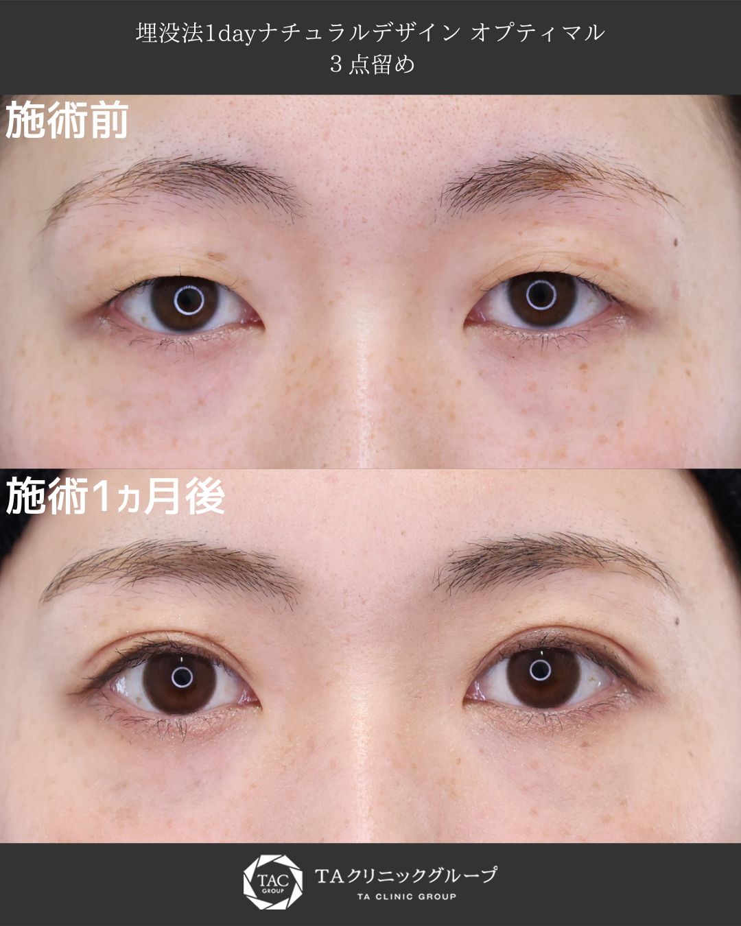 【堂脇医師執刀】1dayでここまで変わる！自然な二重形成ビフォーアフター