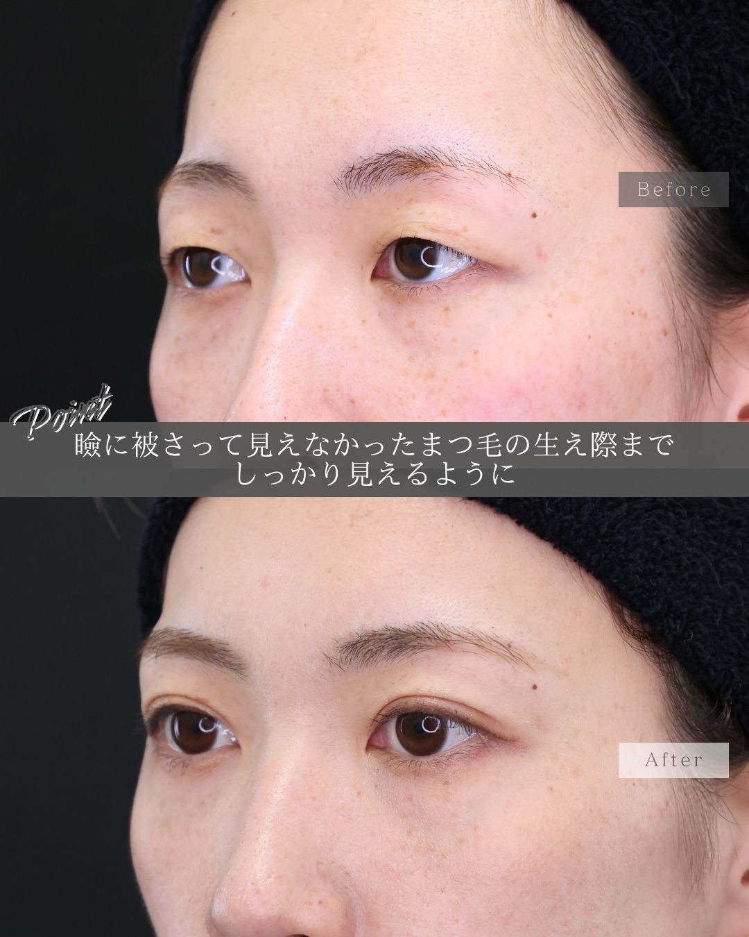 二重埋没法の症例写真 施術前後 