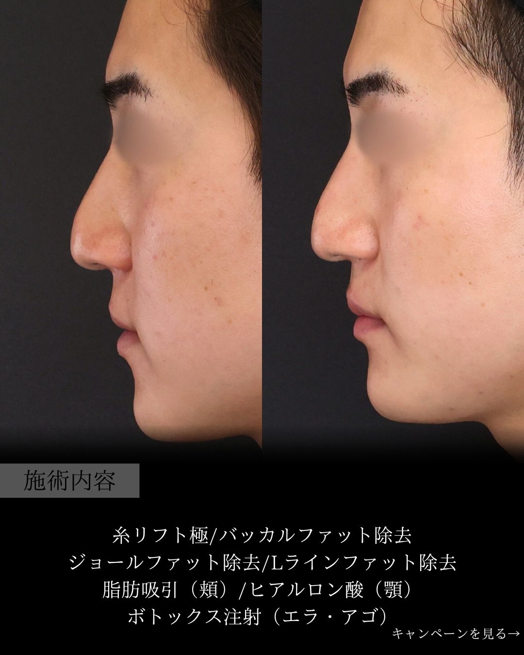 TAC式 ツヤ肌コラーゲンリフト®/バッカルファット除去/ジョールファット除去の症例写真 施術前後 