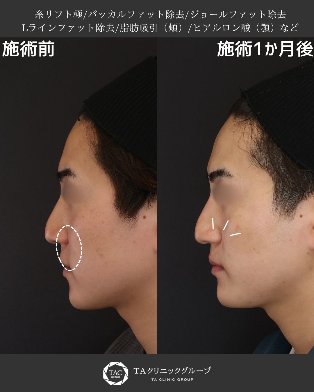 男性の骨格を生かしたシャープな横顔へ｜脂肪除去＋糸リフト＋注入治療