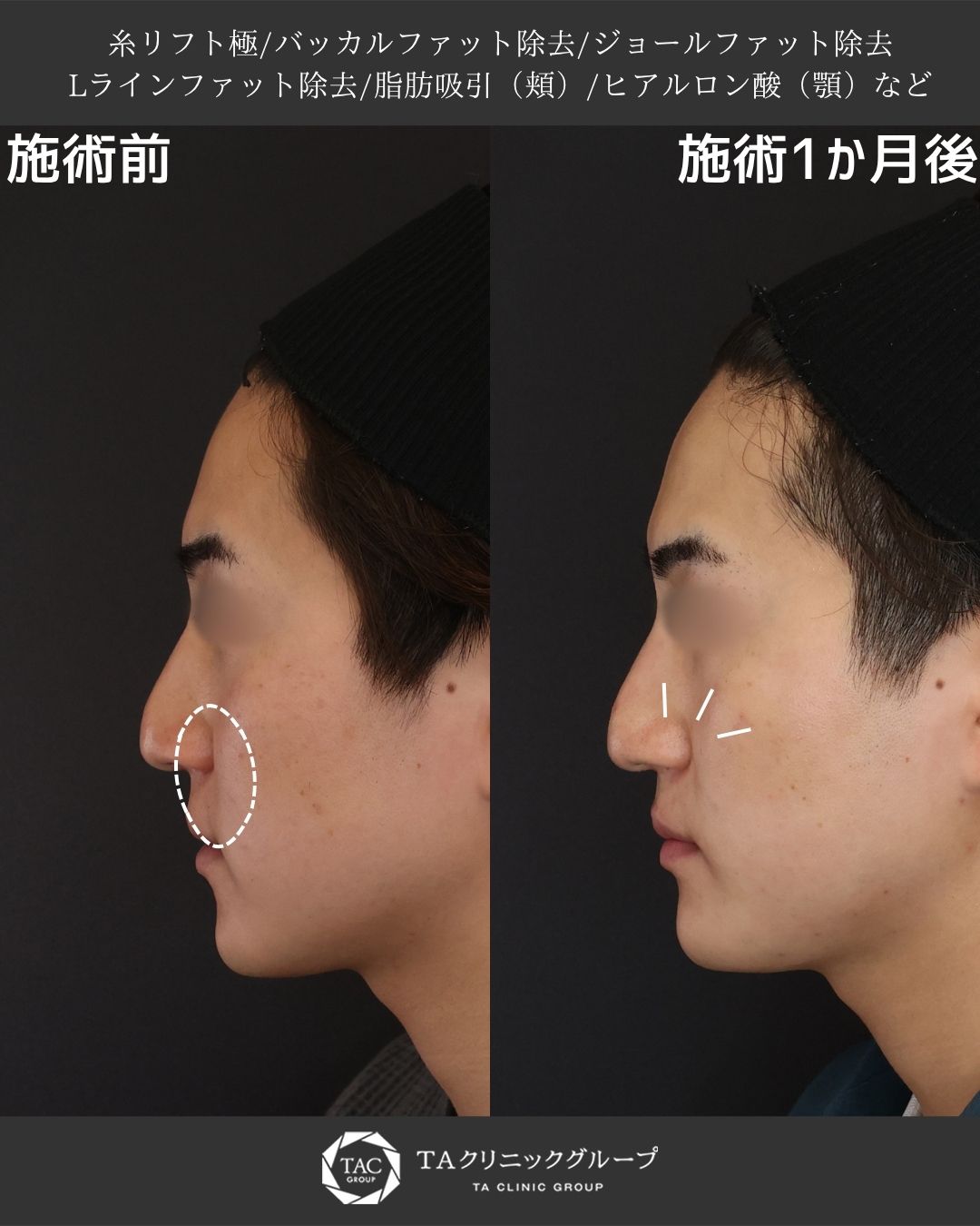 男性の骨格を生かしたシャープな横顔へ｜脂肪除去＋糸リフト＋注入治療