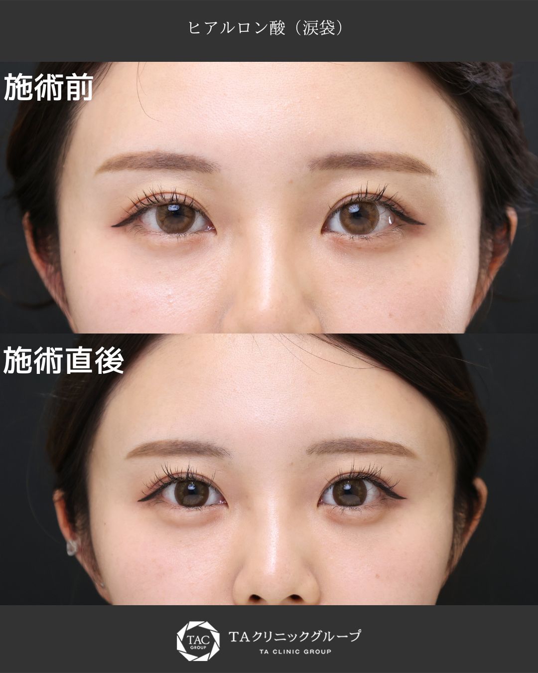 自然なのに印象アップ！ 涙袋ヒアルで“盛れる”目元に