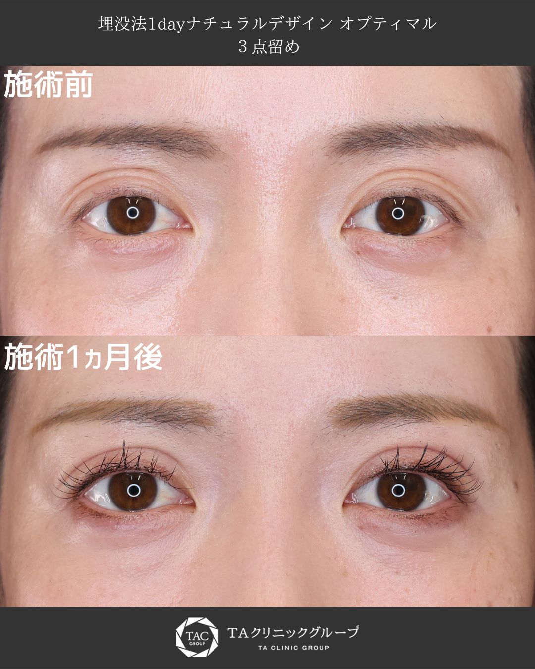 30代から始める理想の二重術 ― 自然で華やかな印象に