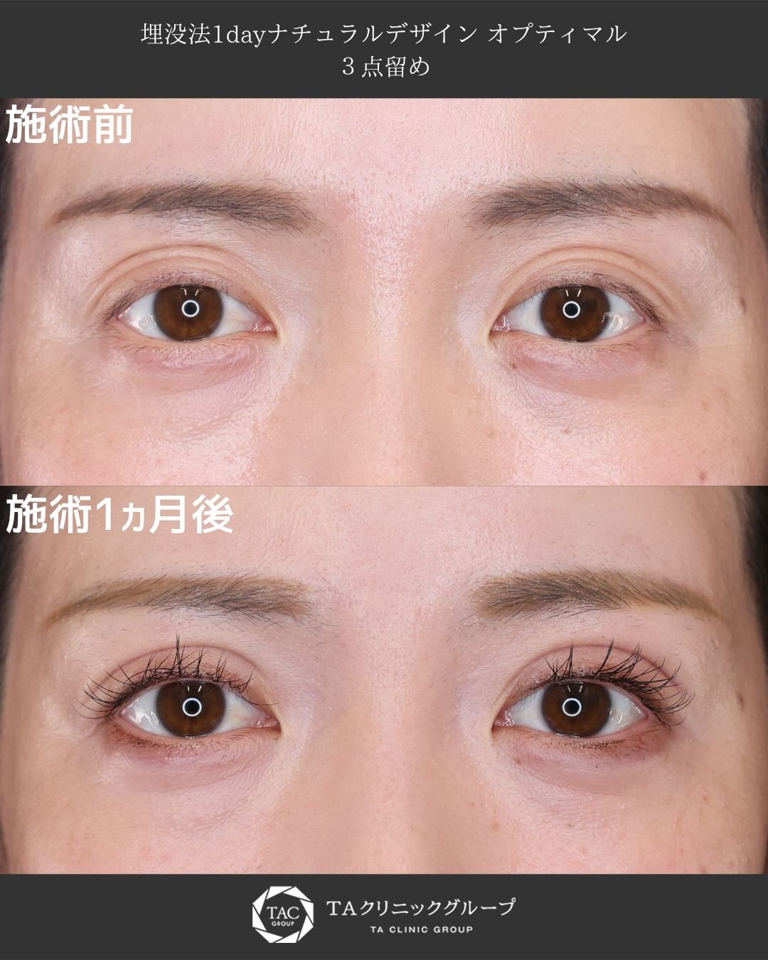 30代から始める理想の二重術 ― 自然で華やかな印象に