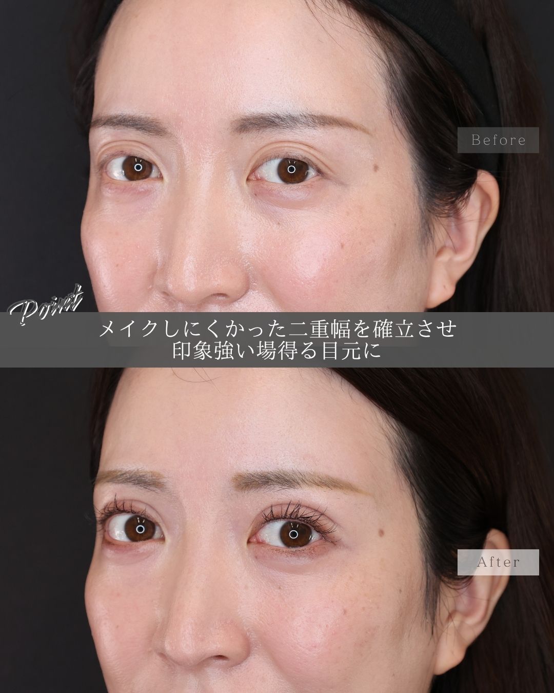 二重埋没法の症例写真 施術前後 