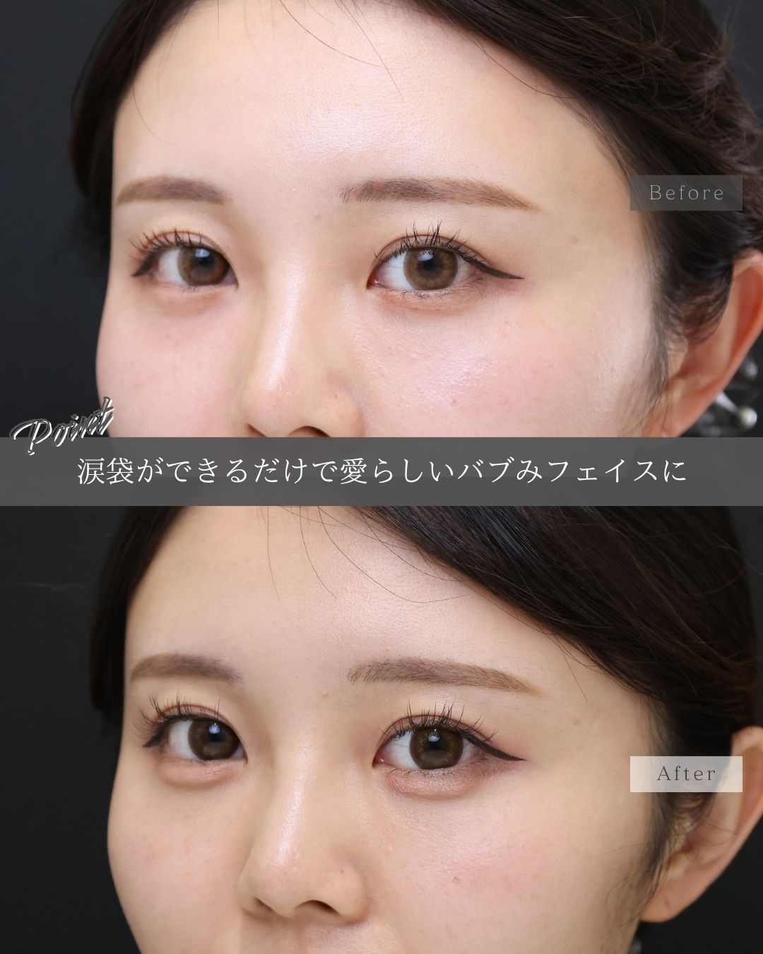 涙袋形成(ヒアルロン酸注射)の症例写真 施術前後