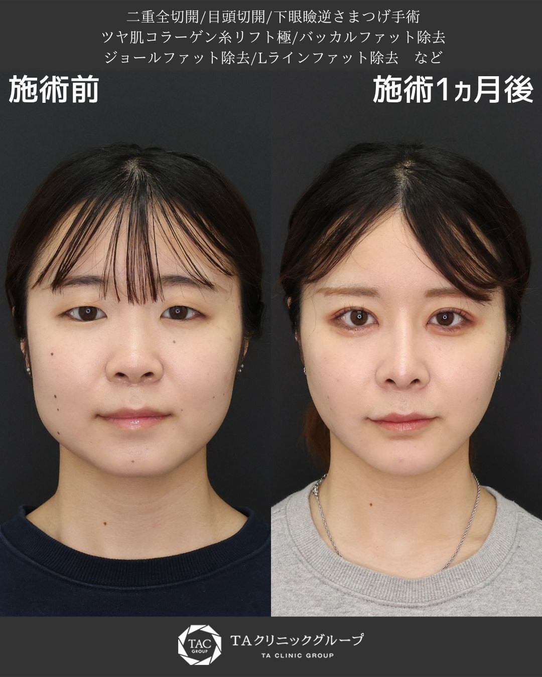 フルフェイスデザインで洗練された美しさへ － 顔全体のバランスを整える総合施術