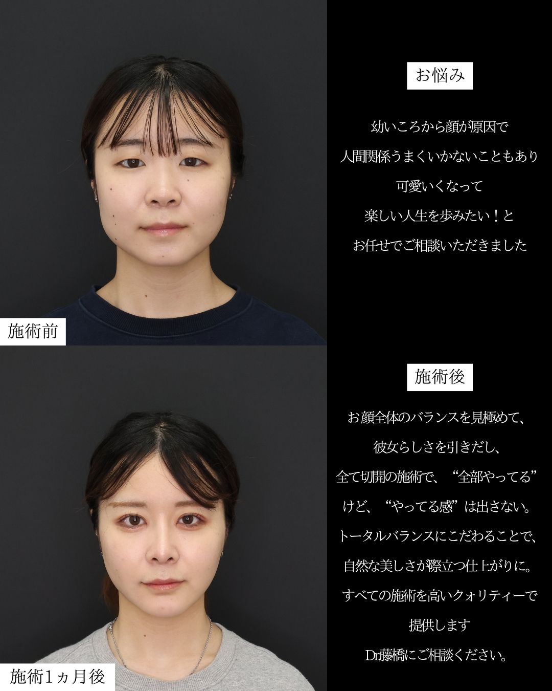 二重切開（全切開法）/目頭切開術/TAC式 ツヤ肌コラーゲンリフト®の症例写真 施術前後 