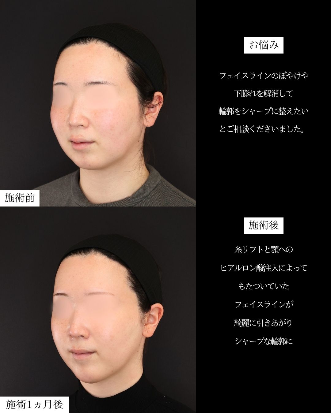 TAC式 ツヤ肌コラーゲンリフト®/ボトックス注射：その他/エラボトックス注射の症例写真 施術前後 