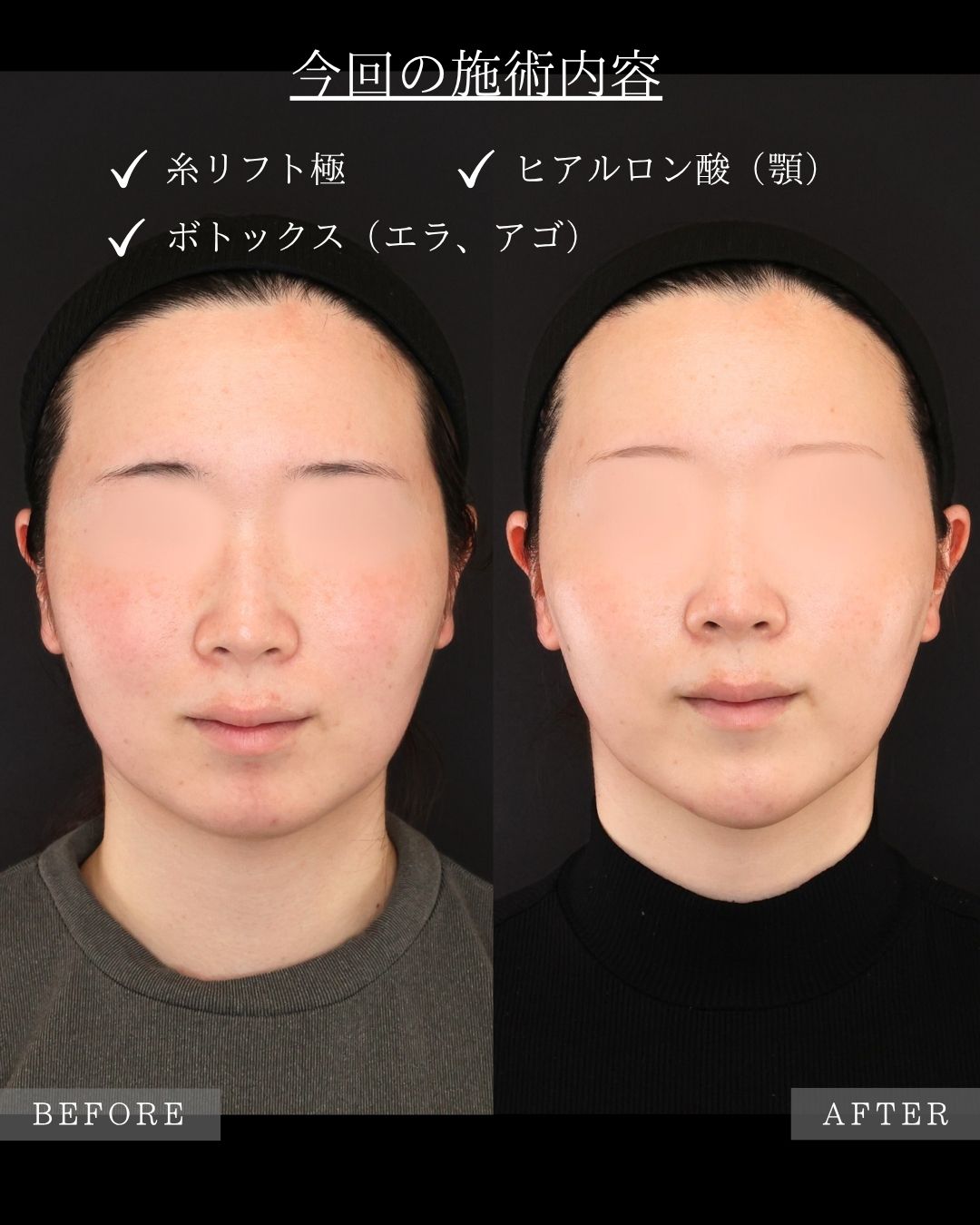 TAC式 ツヤ肌コラーゲンリフト®/ボトックス注射：その他/エラボトックス注射の症例写真 施術前後 