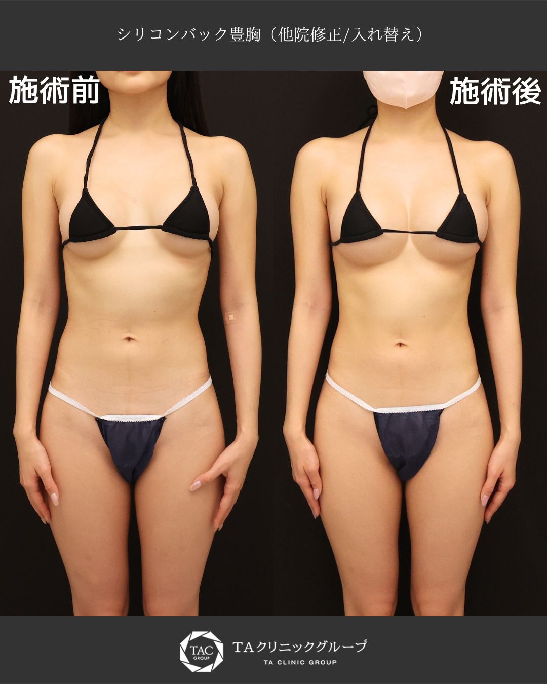 【安全安心の女医が執刀】シリコンバック豊胸でも自然に大きく