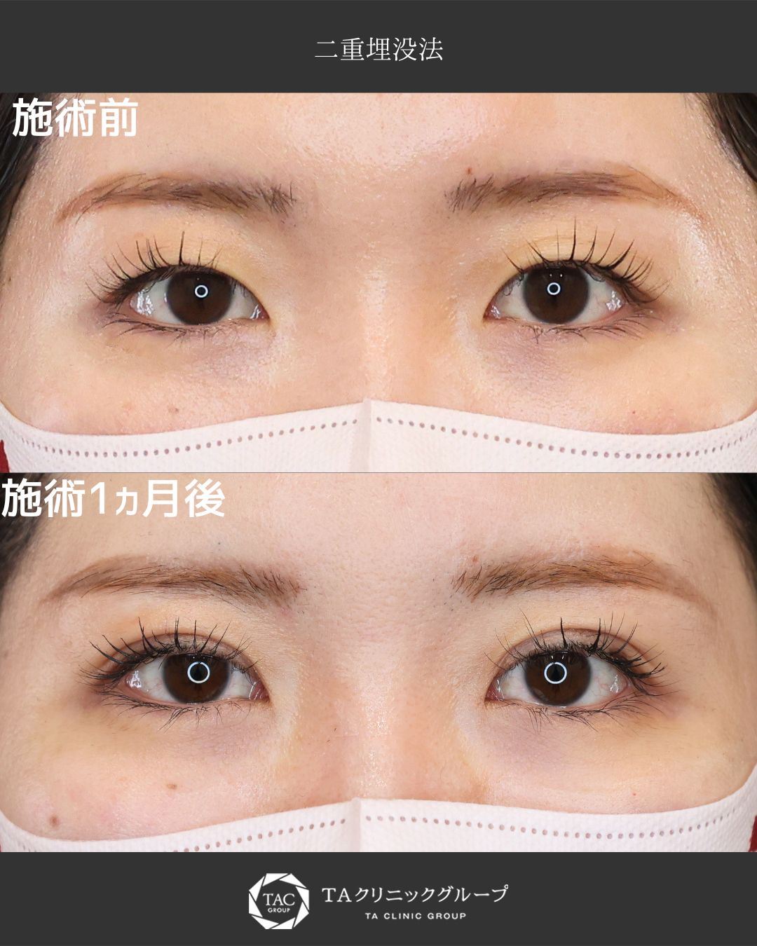 【形成外科専門医】目元が生き返る二重術