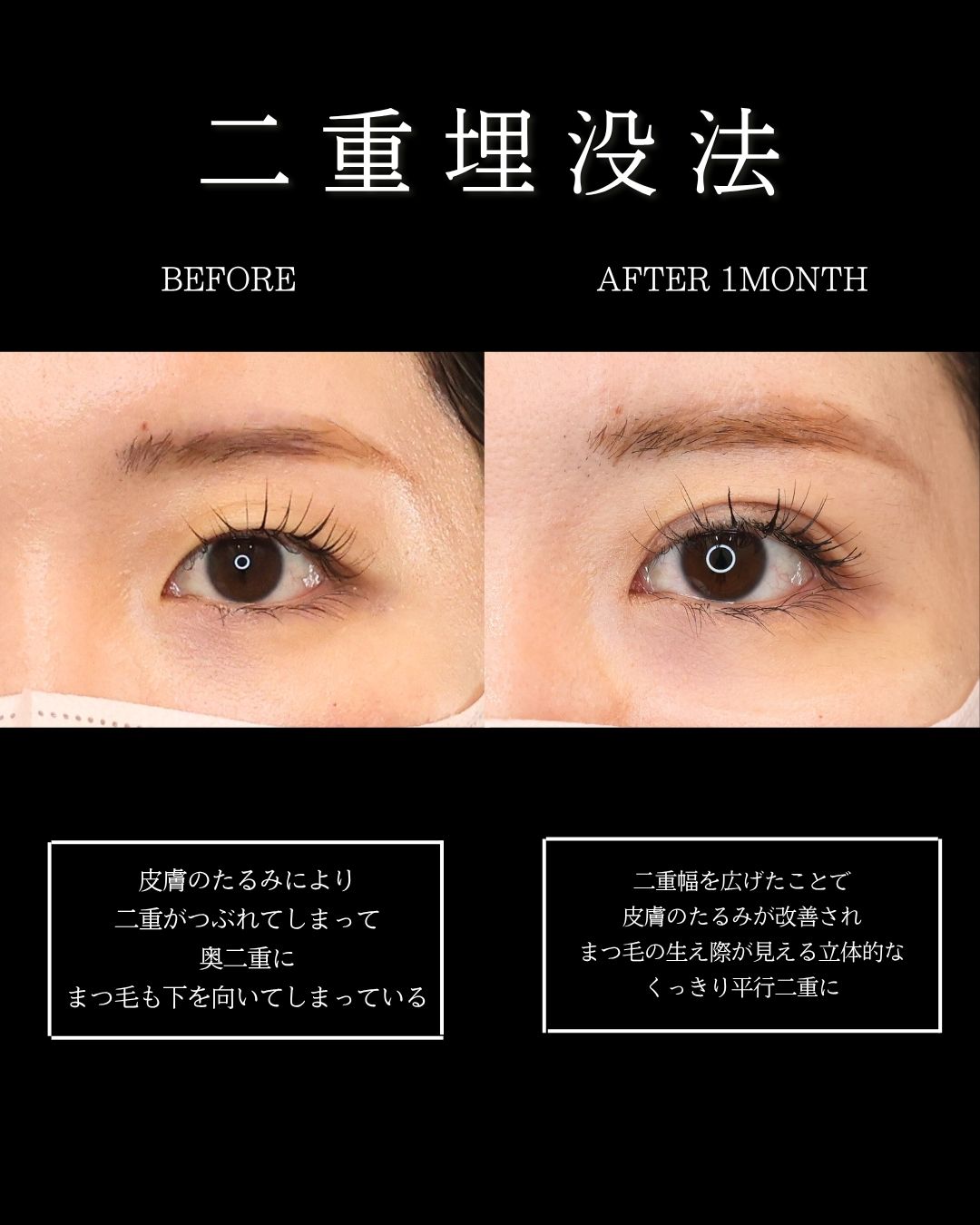 二重埋没法の症例写真 施術前後 